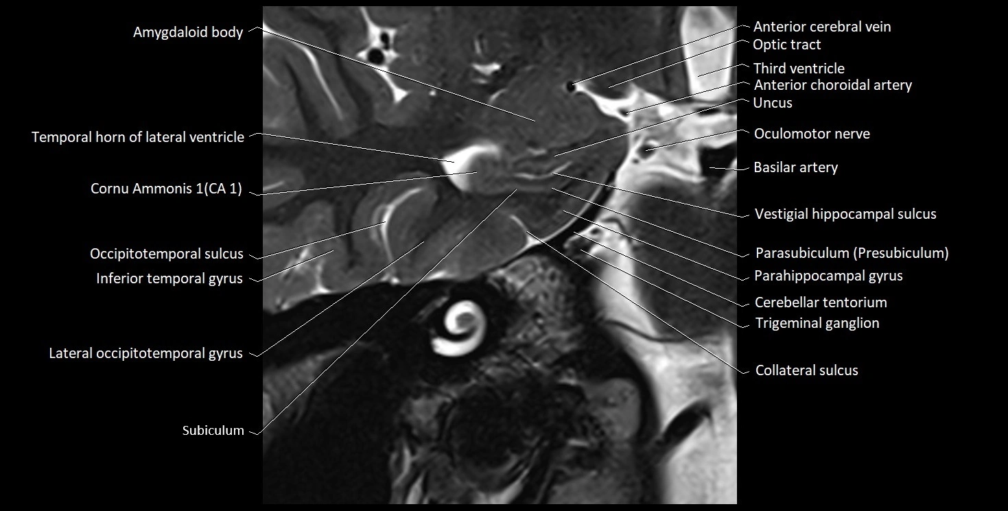 Hippocampus anatomy mri coronal cross section 3T MRI image 2.webp